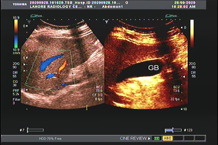 Best Abdominal ultrasound in lahore 