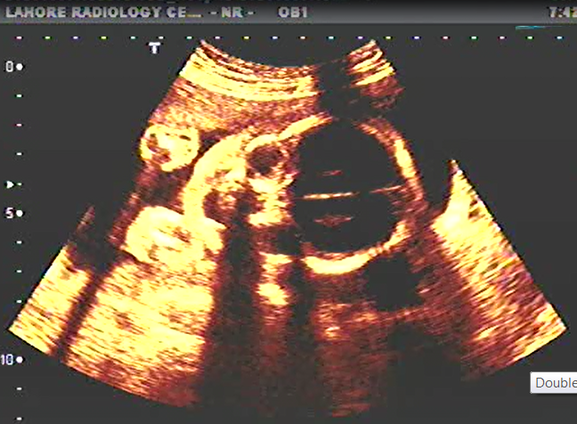 OBS ULTRASOUND