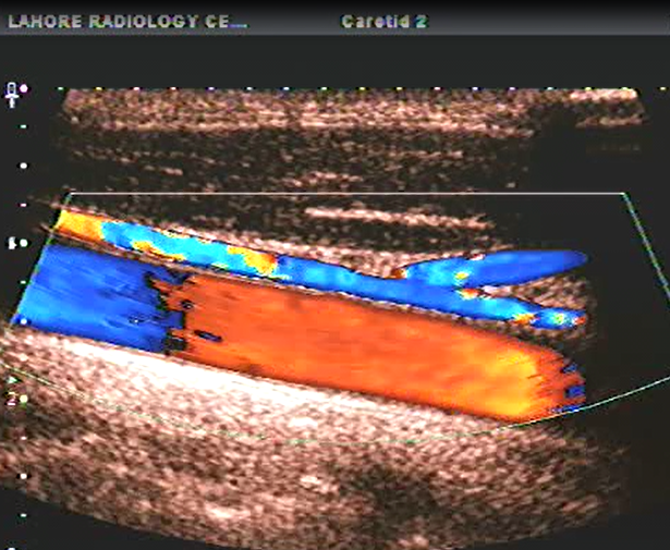 Carotid Doppler in Lahore