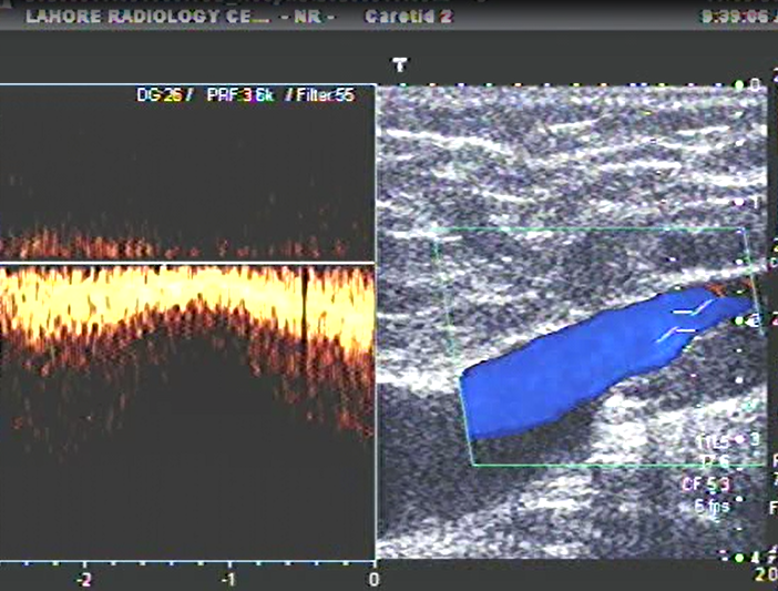 Lower limb doppler in Lahore