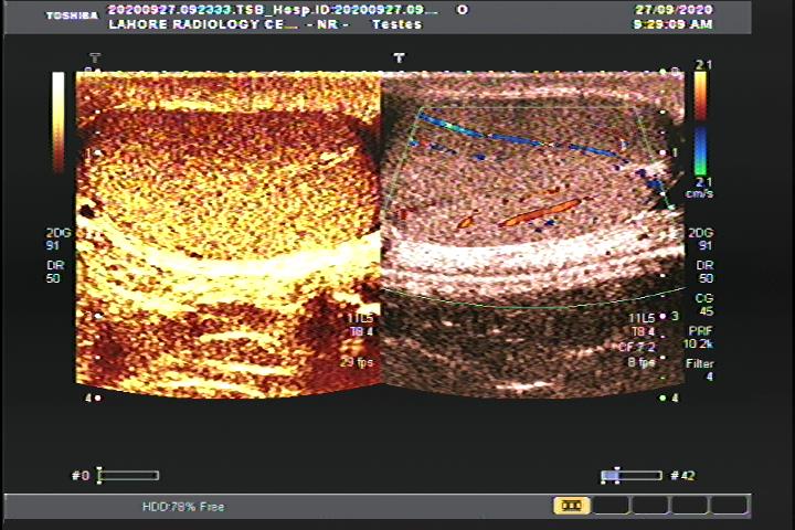 Scrotal and testicular color doppler 